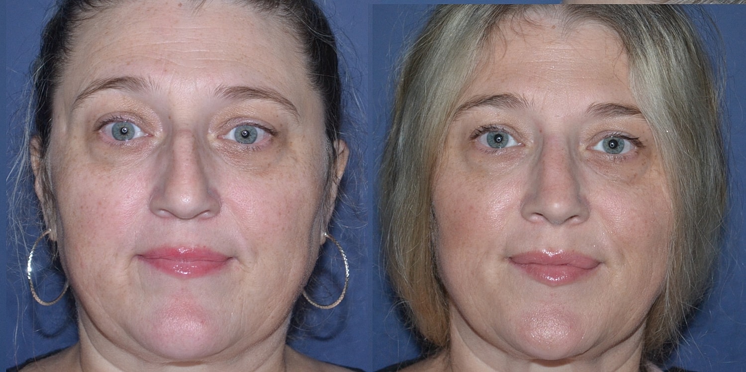 Rhinoplasty Before & After