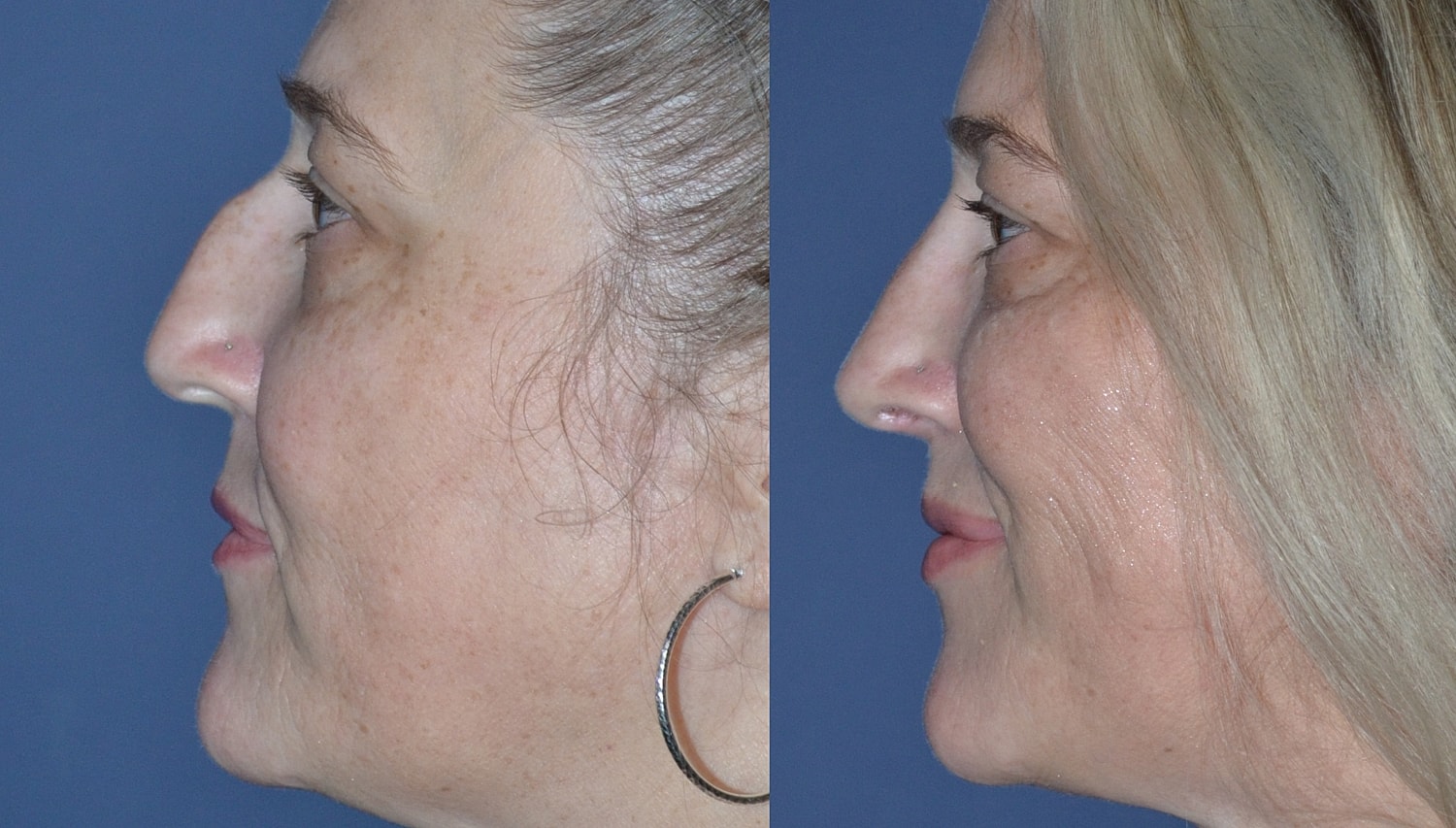 Rhinoplasty Before & After