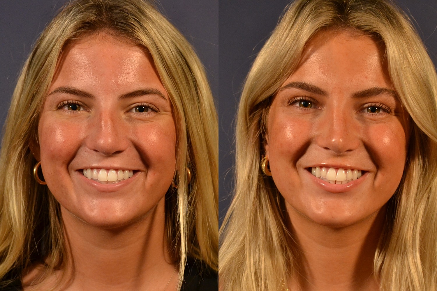 Rhinoplasty Before & After