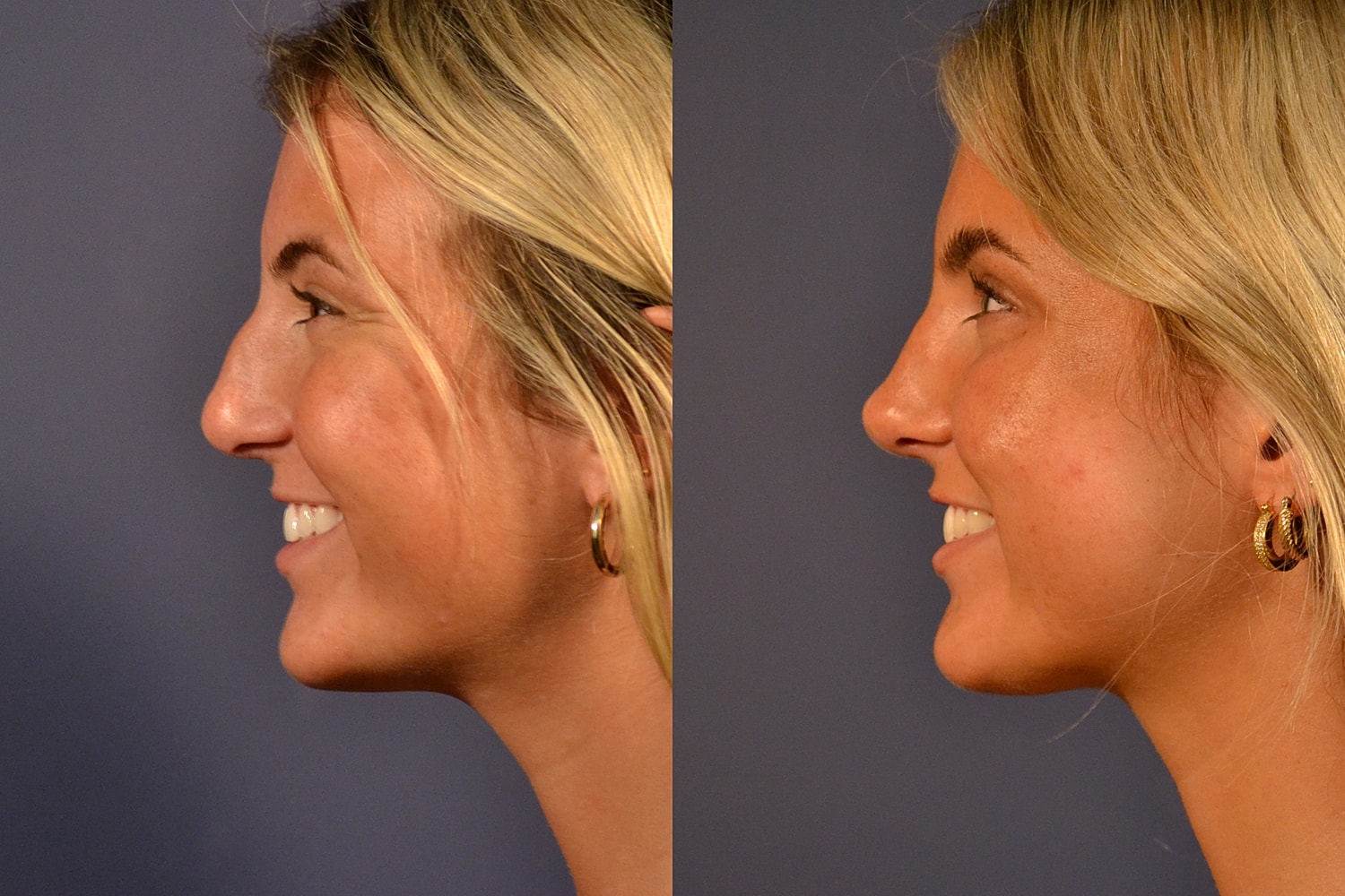 Rhinoplasty Before & After