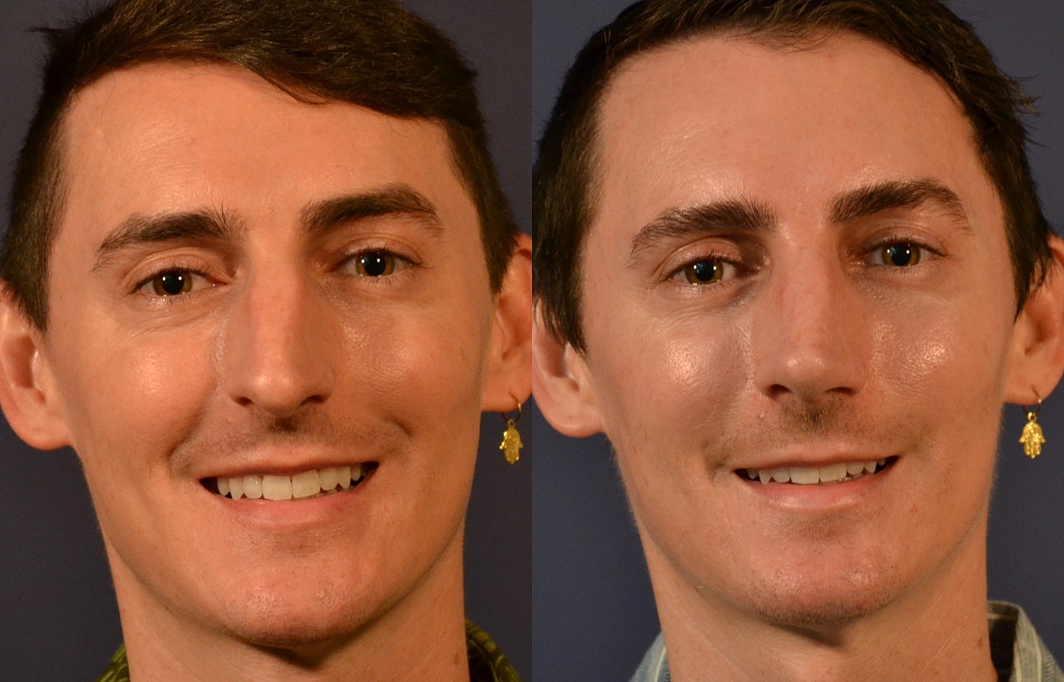 Rhinoplasty Before & After