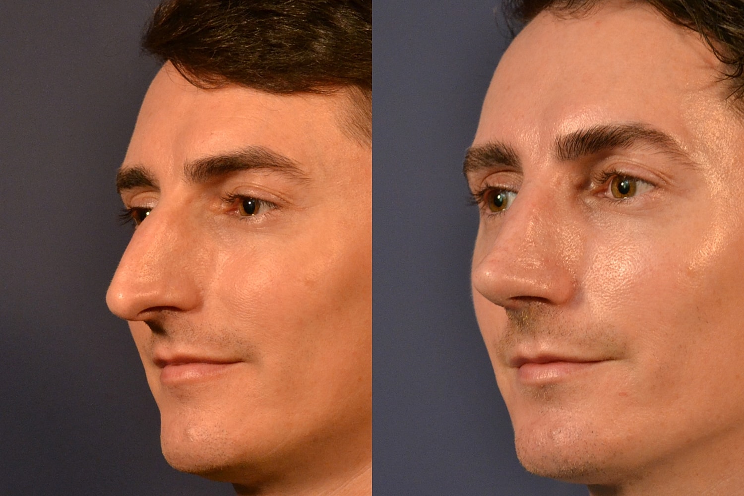 Rhinoplasty Before & After