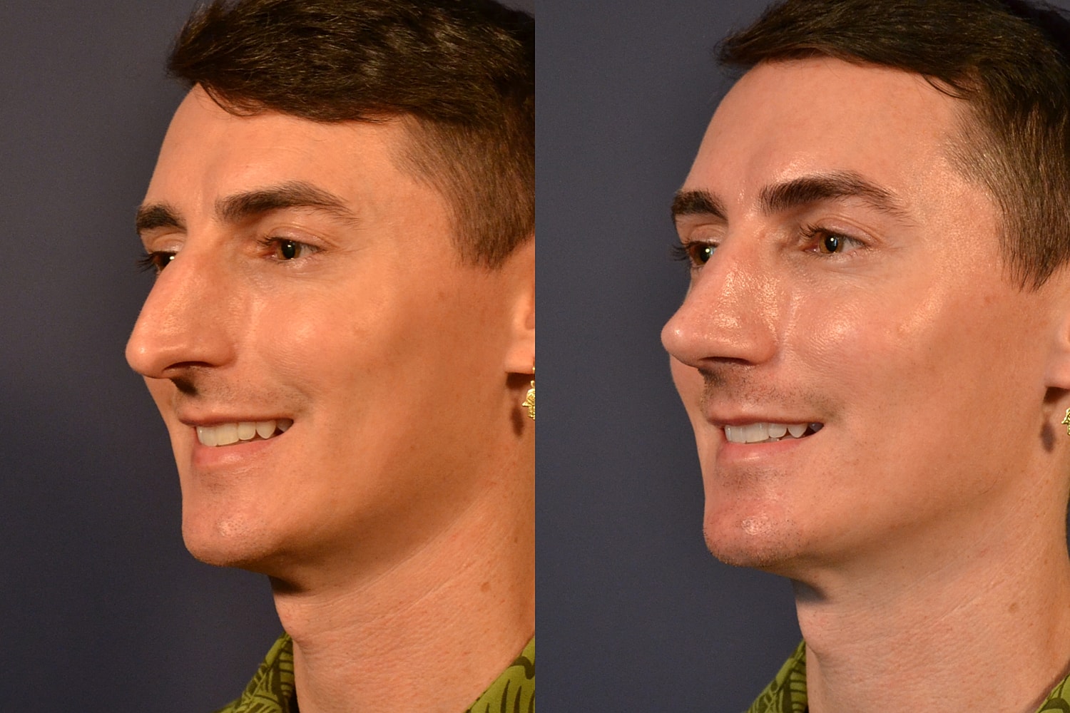 Rhinoplasty Before & After