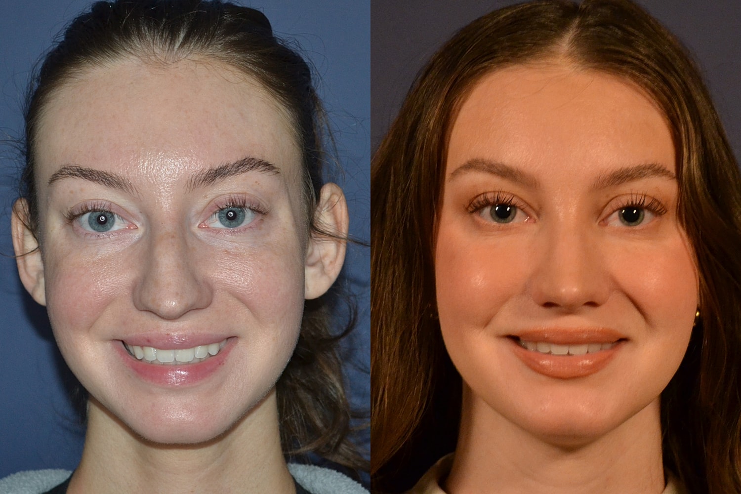 Rhinoplasty Before & After