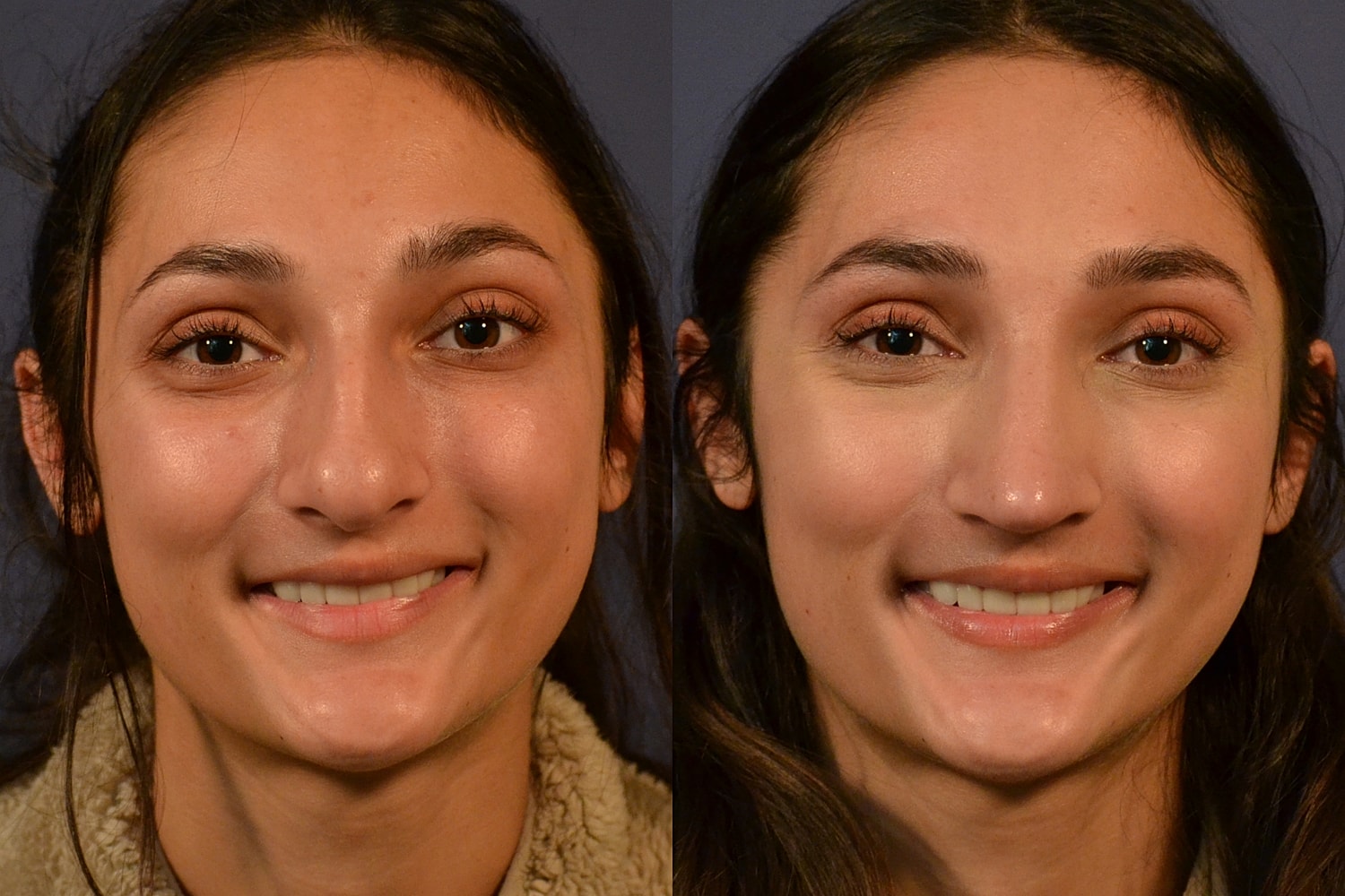 Rhinoplasty Before & After