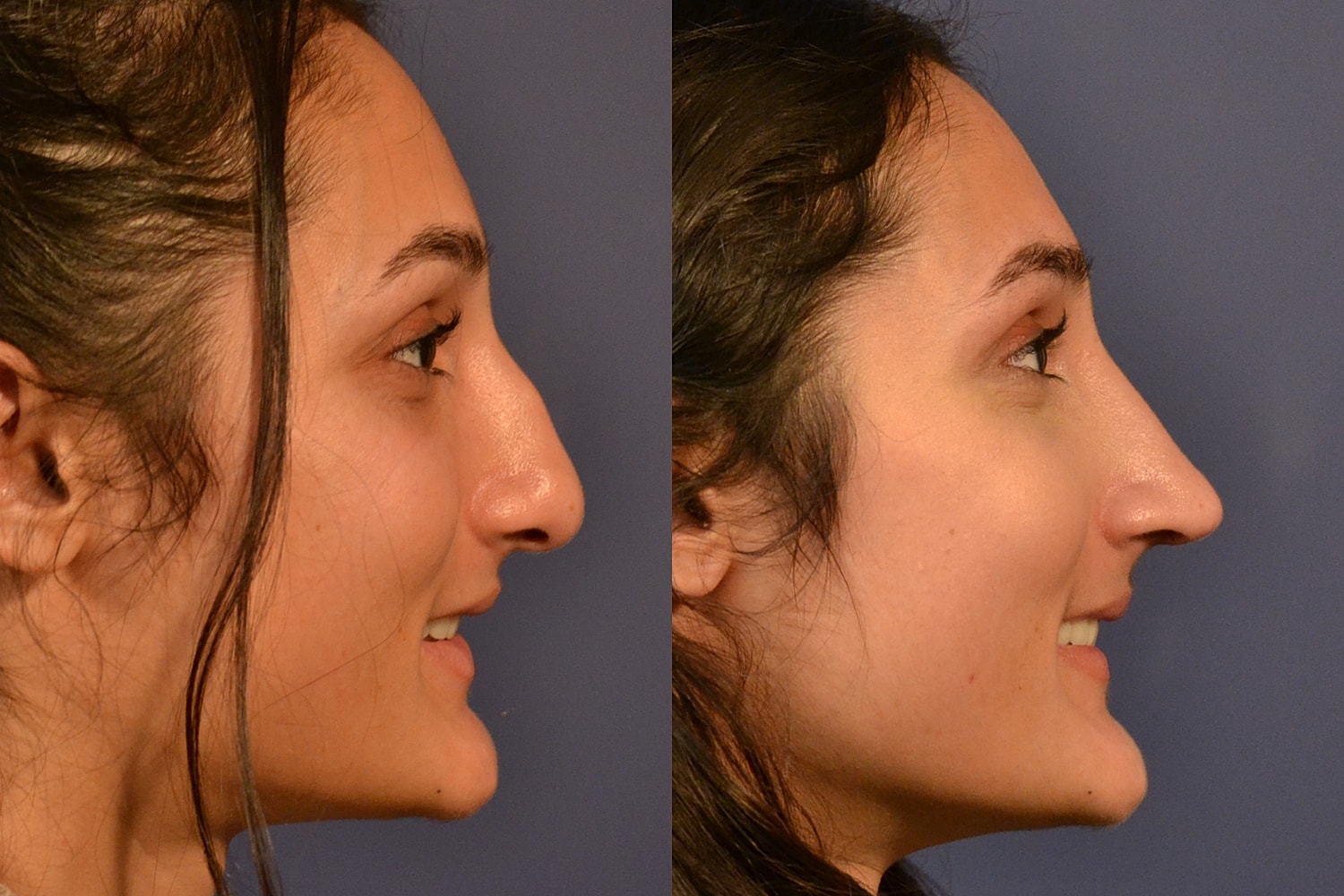 Rhinoplasty Before & After