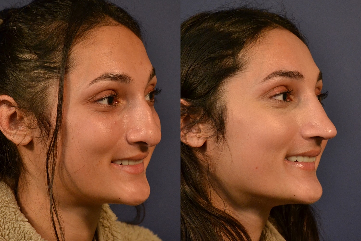 Rhinoplasty Before & After
