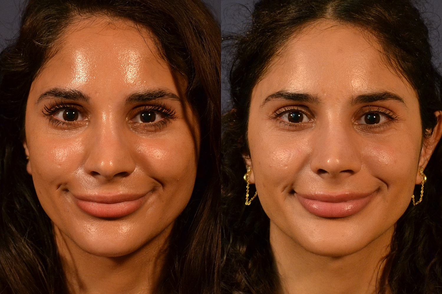 Rhinoplasty Before & After