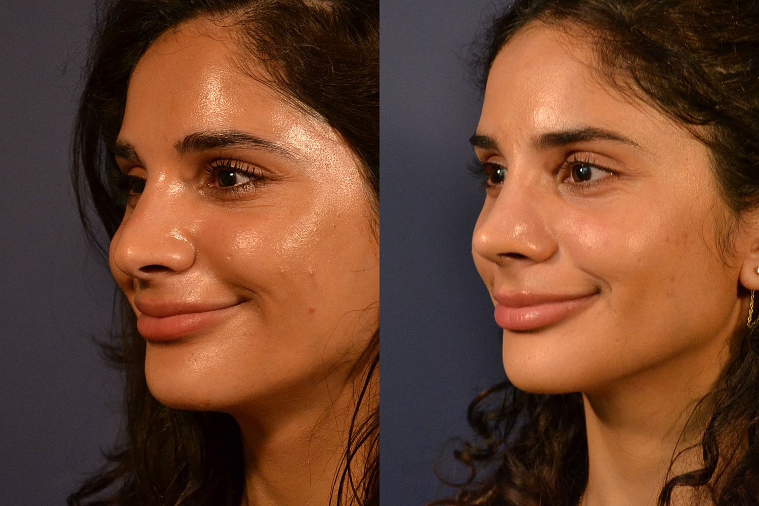 Rhinoplasty Before & After