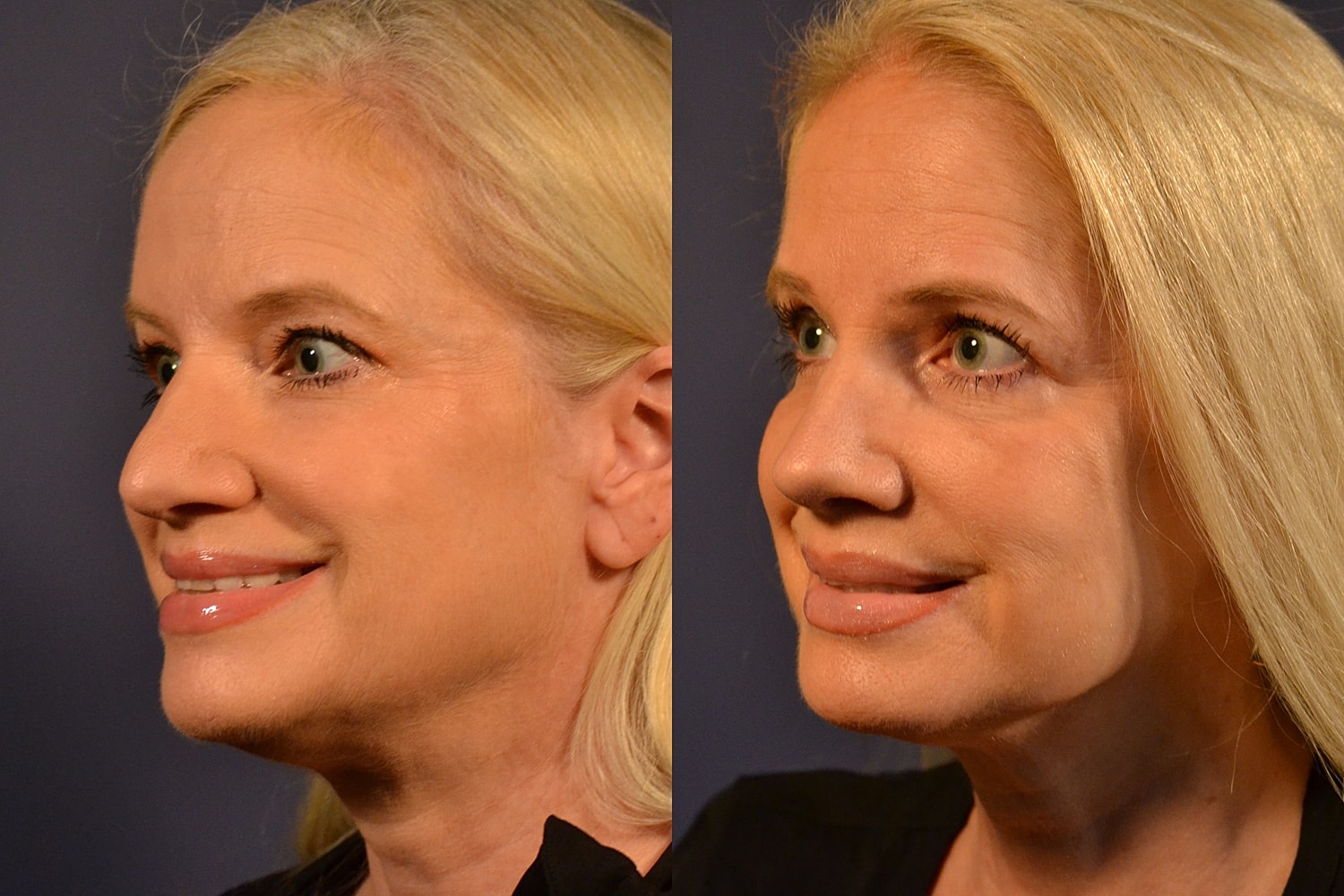 Before and after cosmetic enhancement side profile.