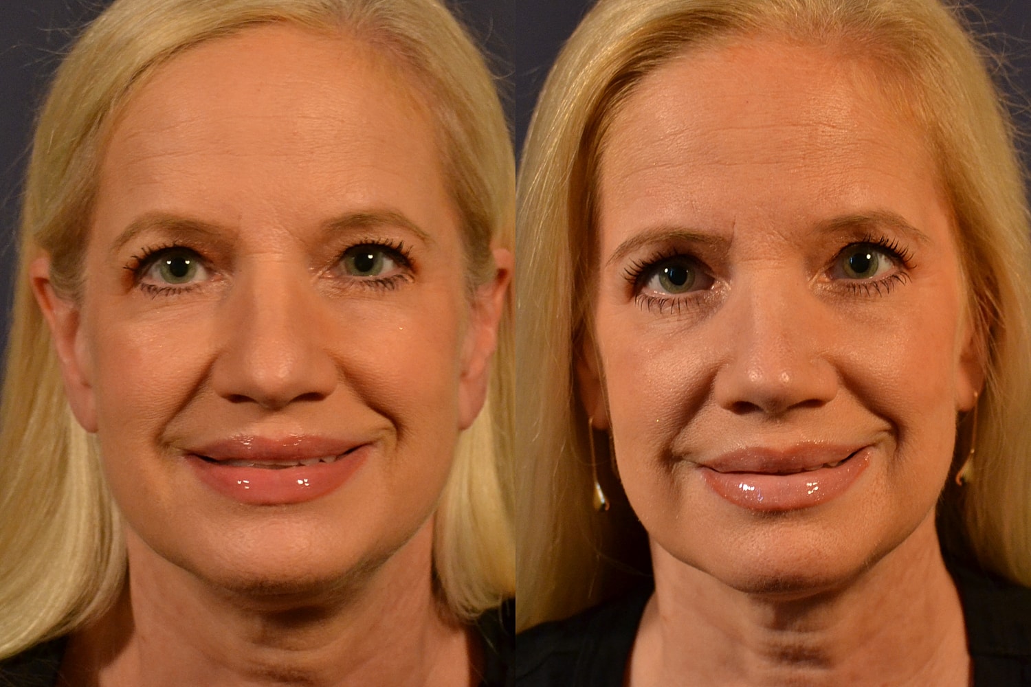 Before and after photo showing facial enhancements.