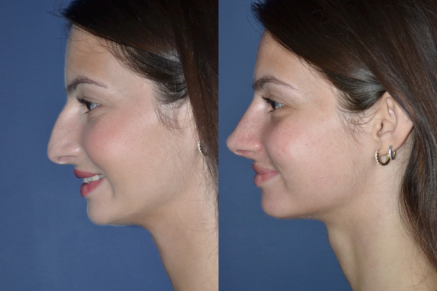 Rhinoplasty Before & After