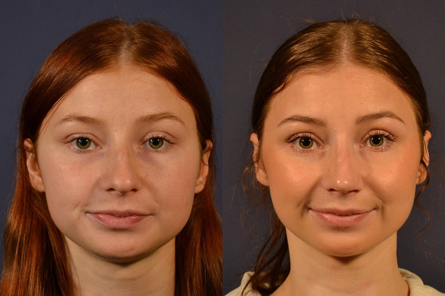 Rhinoplasty Before & After