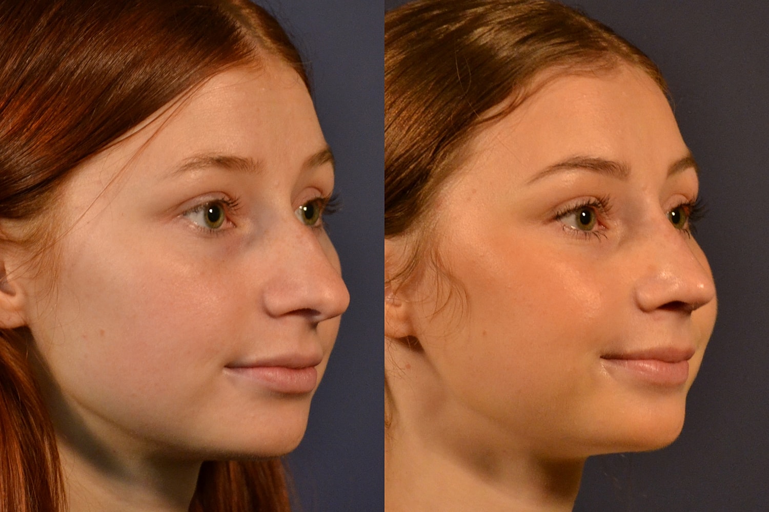 Rhinoplasty Before & After