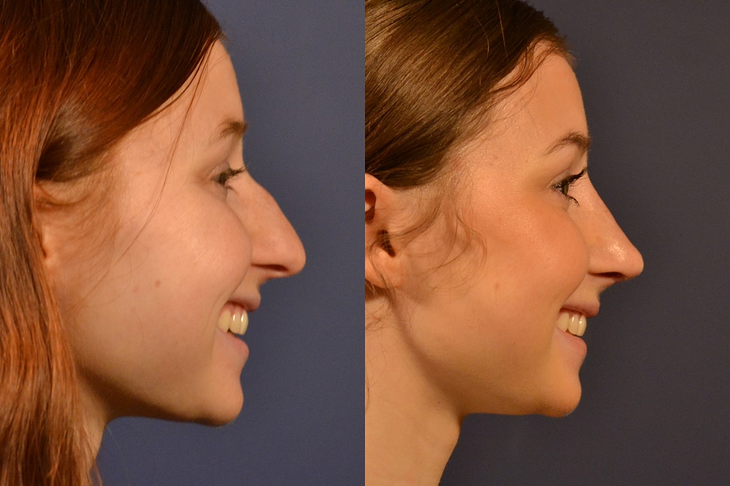 Rhinoplasty Before & After