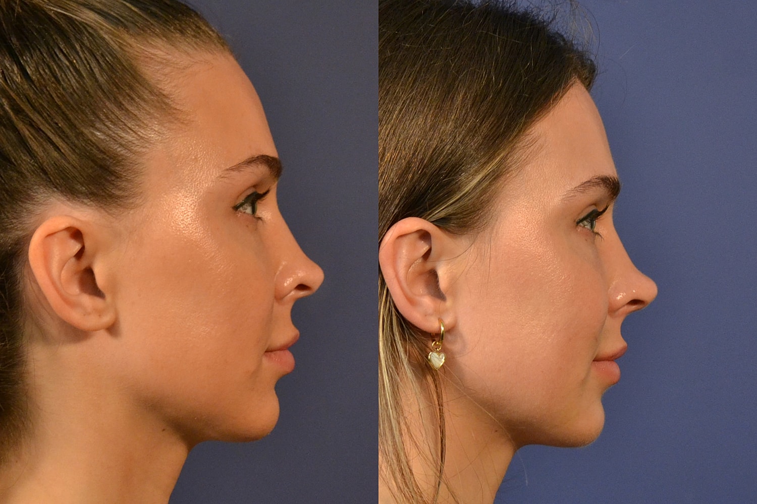 Rhinoplasty Before & After