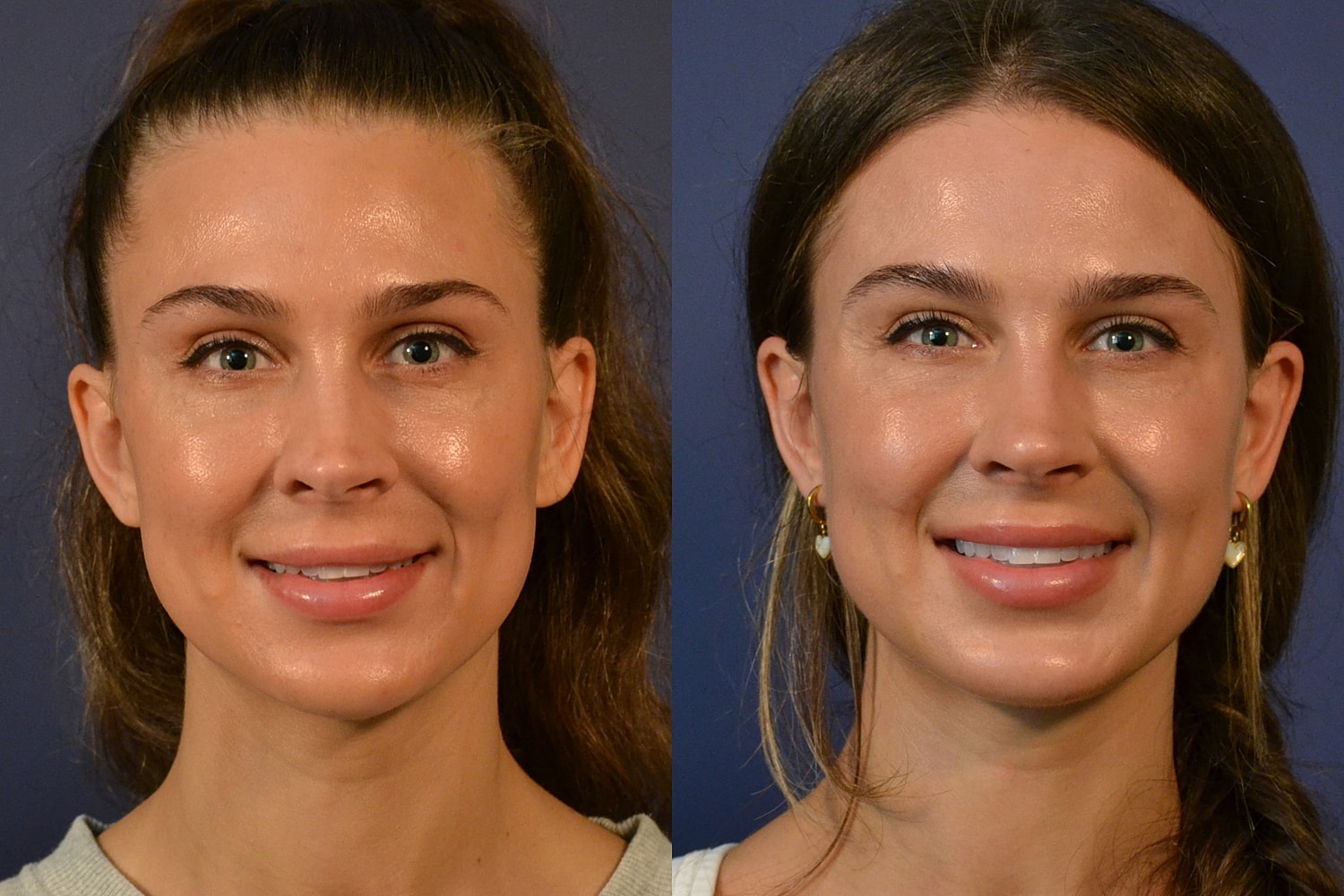 Rhinoplasty Before & After