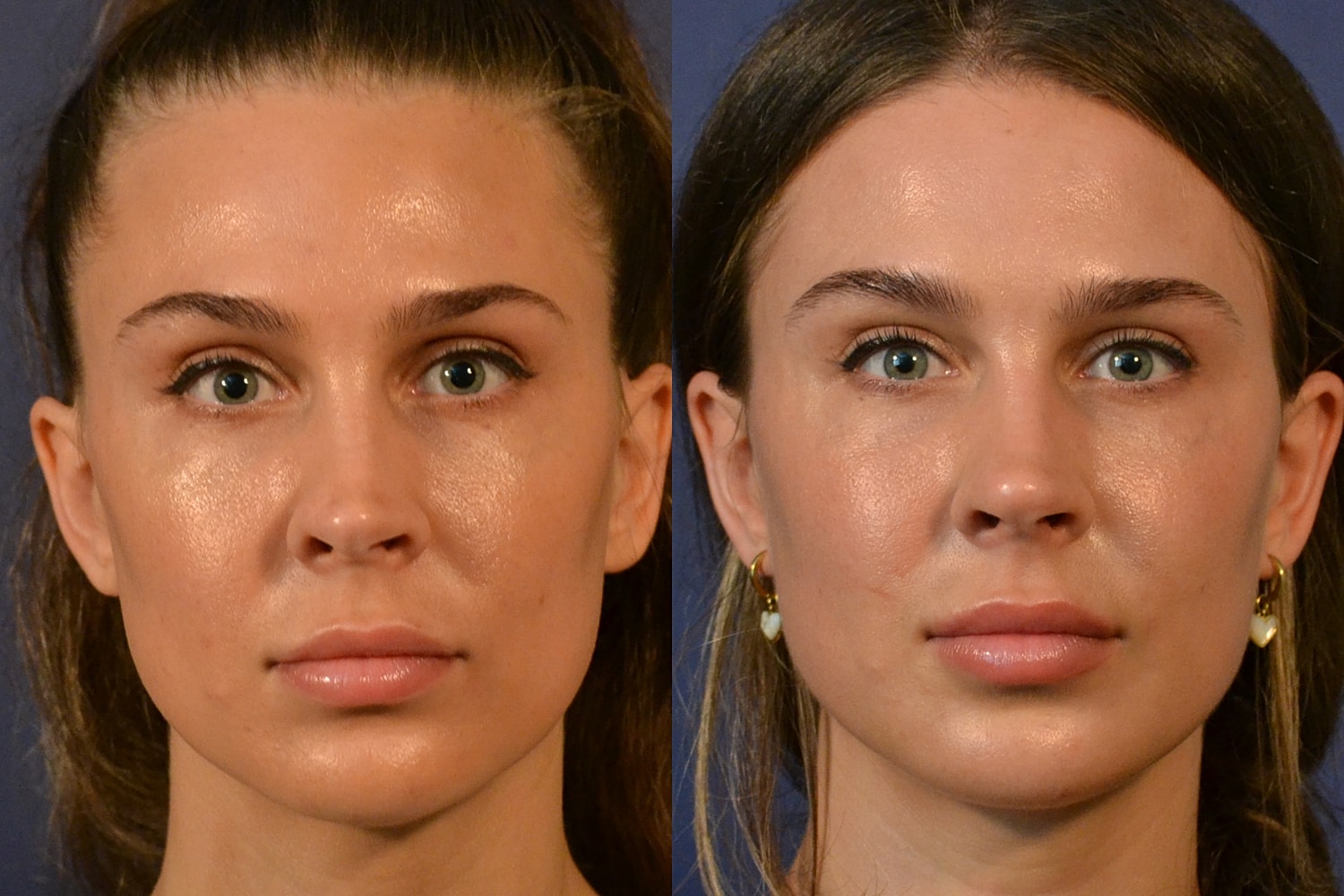 Rhinoplasty Before & After