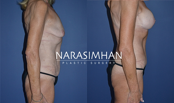 Breast Enhancement Before & After