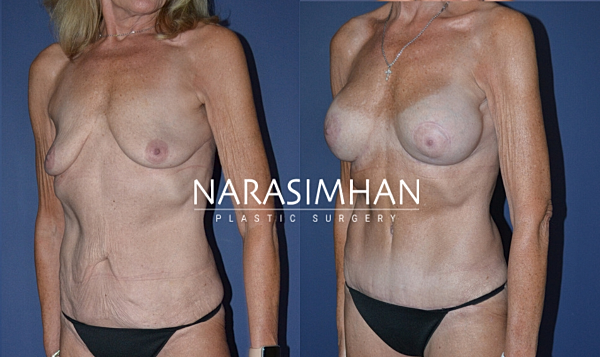 Breast Enhancement Before & After