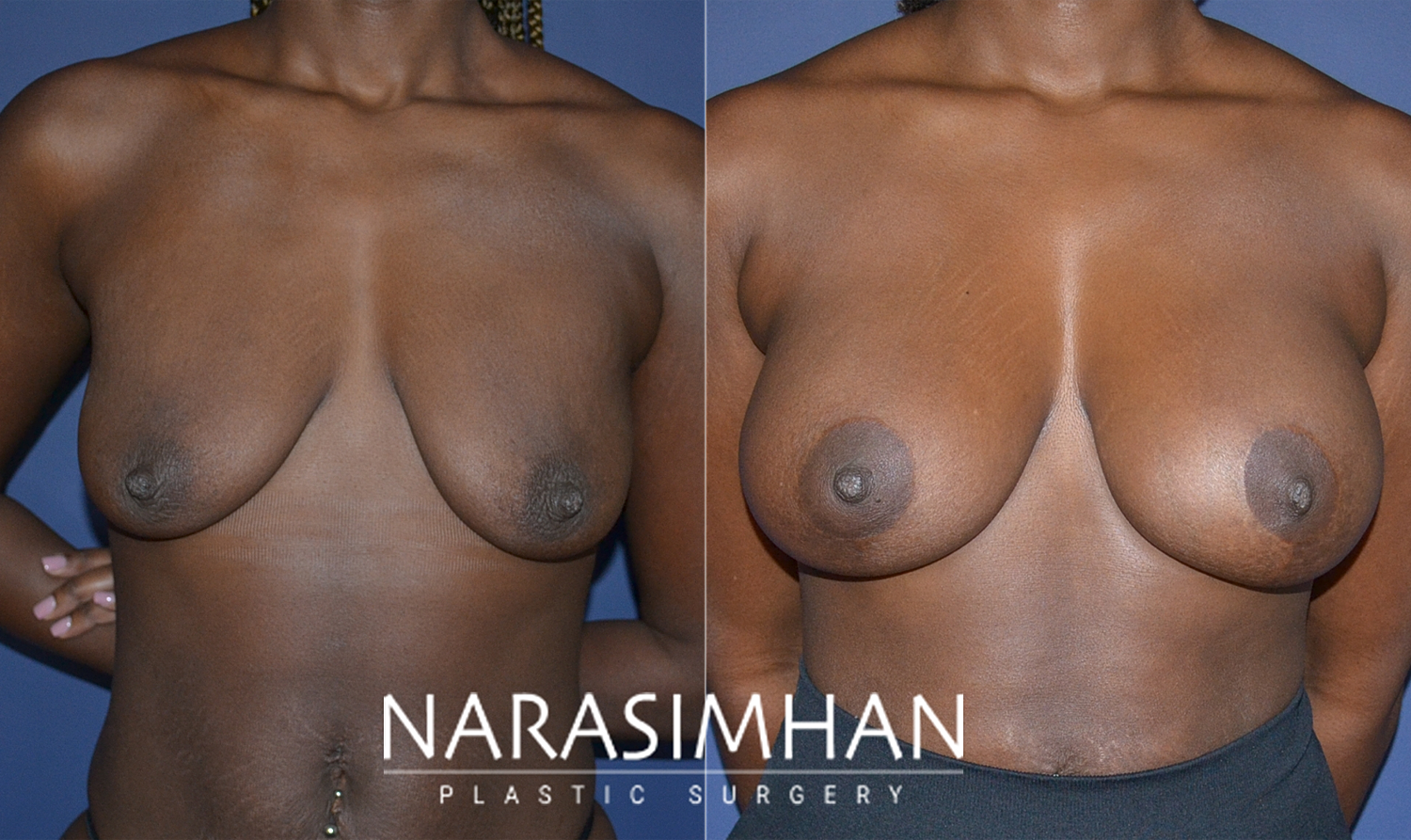 Breast Enhancement Before & After