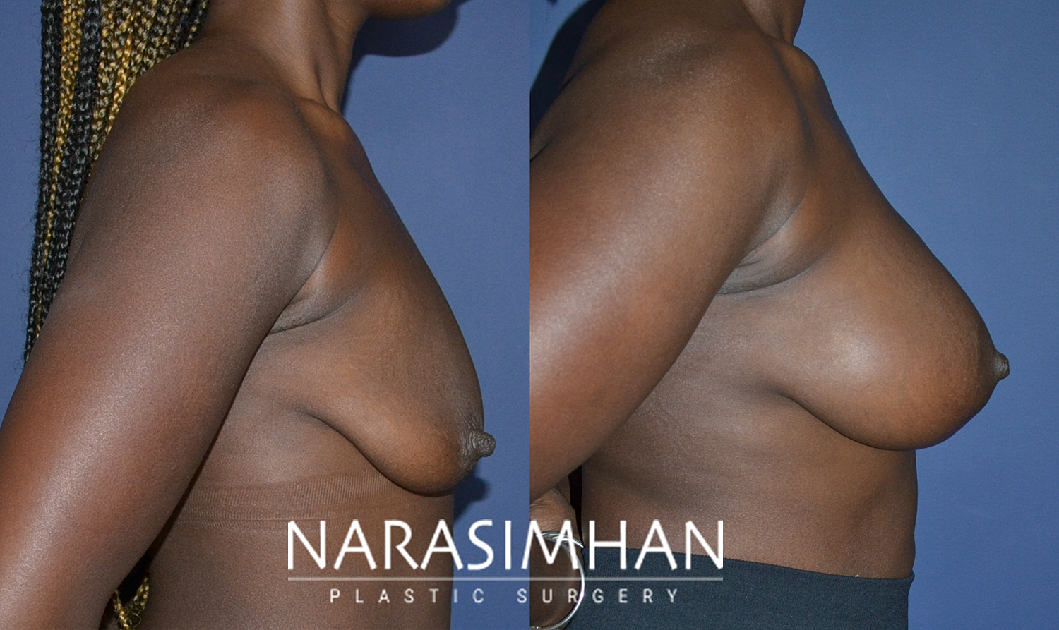 Breast Enhancement Before & After