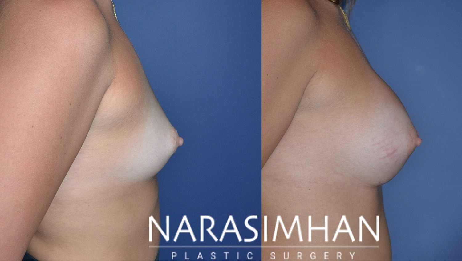 Breast Enhancement Before & After