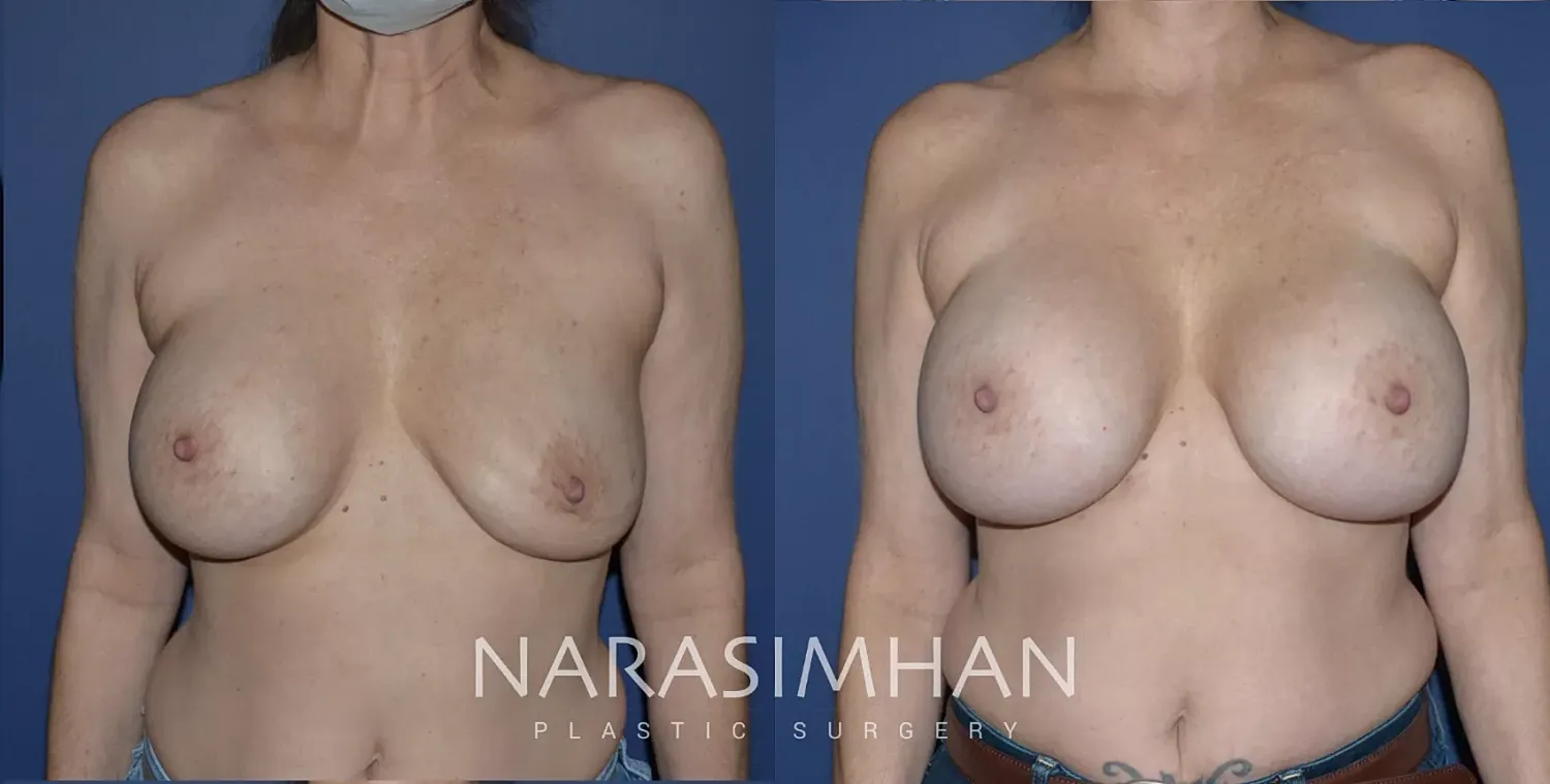 Breast Enhancement Before & After