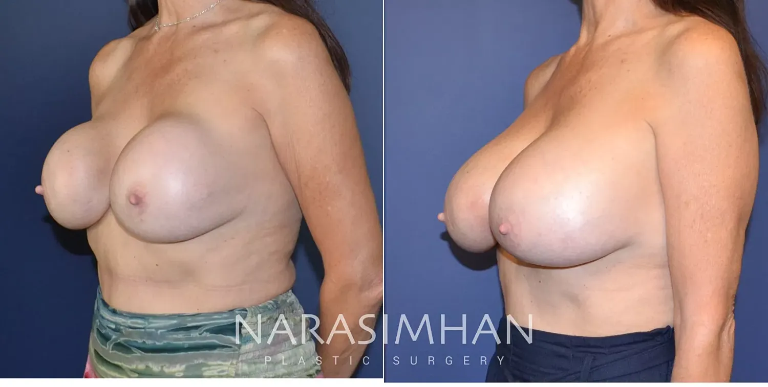 Breast Enhancement Before & After