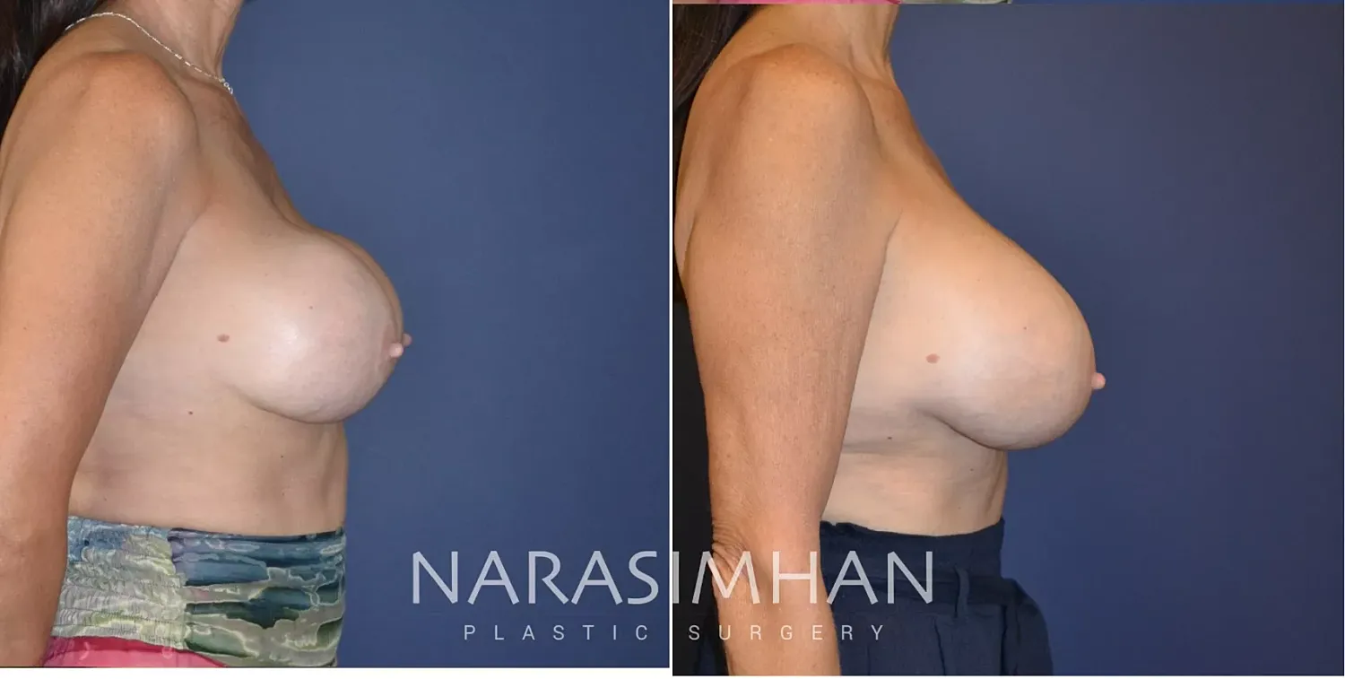 Breast Enhancement Before & After