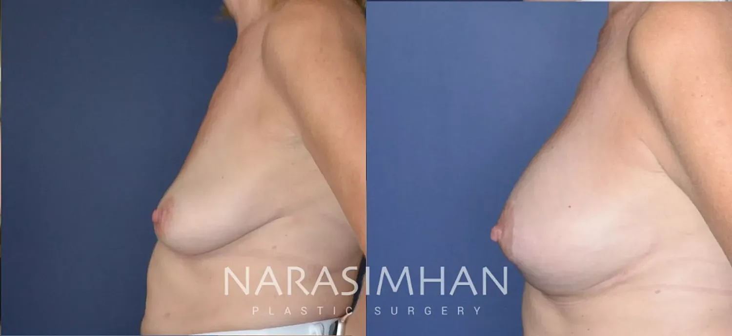 Breast Enhancement Before & After