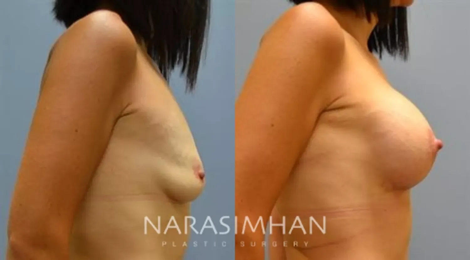 Breast Enhancement Before & After