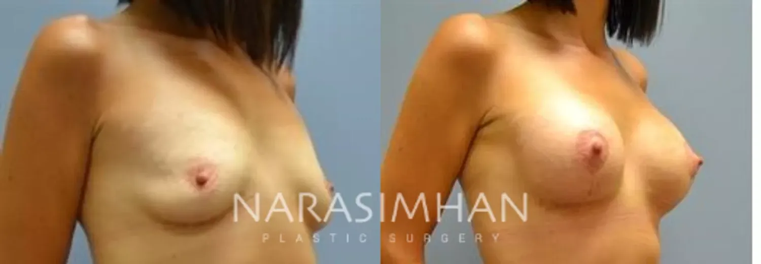 Breast Enhancement Before & After