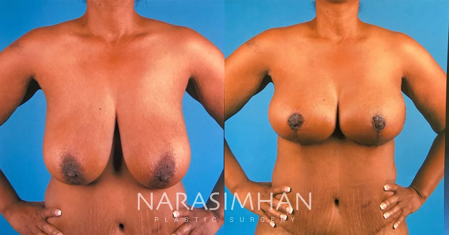Breast Enhancement Before & After