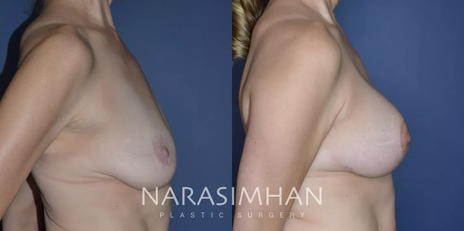 Breast Enhancement Before & After