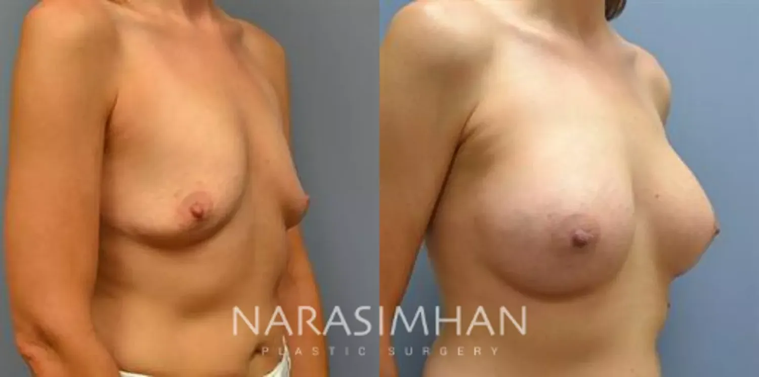 Breast Enhancement Before & After