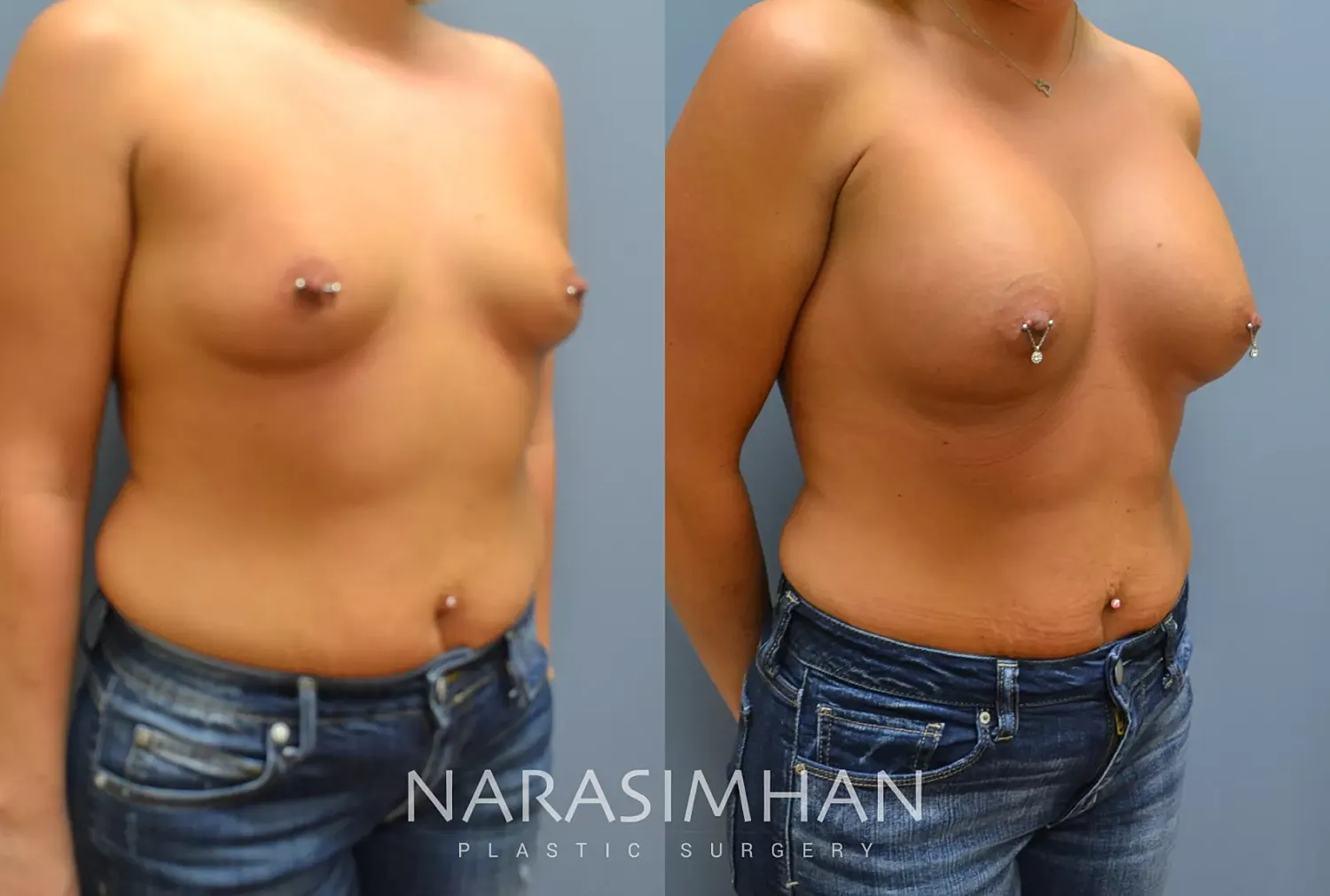 Breast Enhancement Before & After