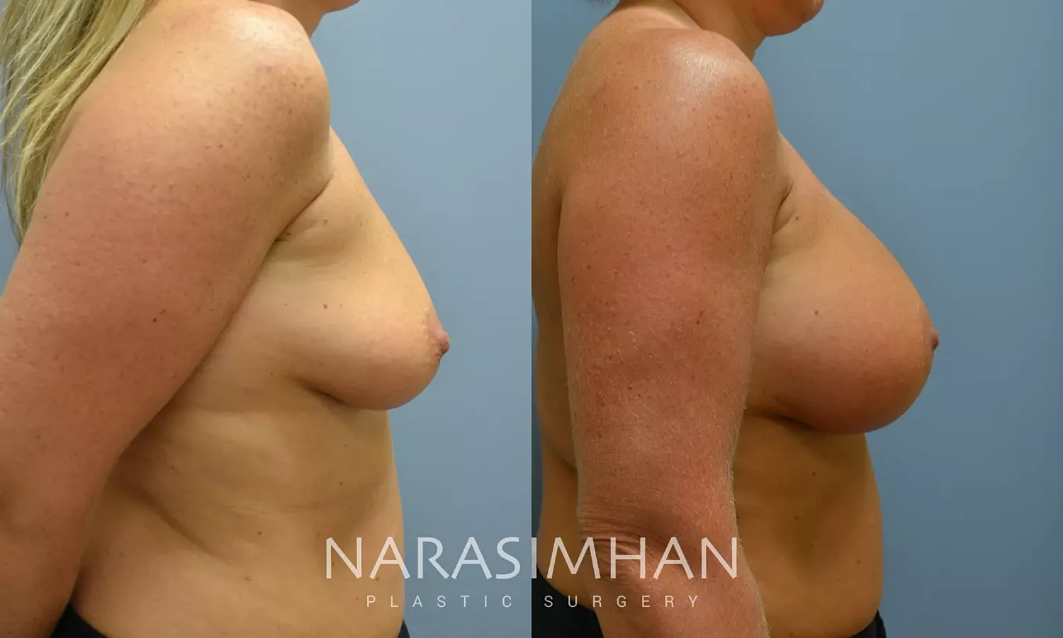 Breast Enhancement Before & After