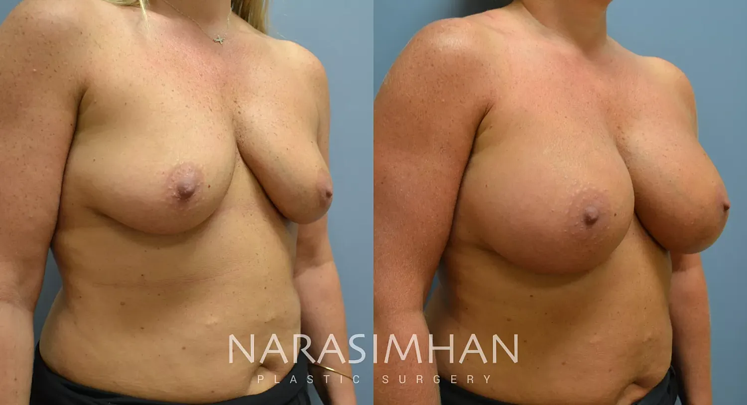 Breast Enhancement Before & After
