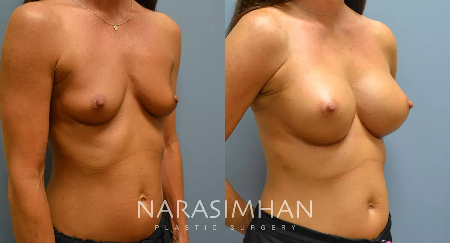 Breast Enhancement Before & After