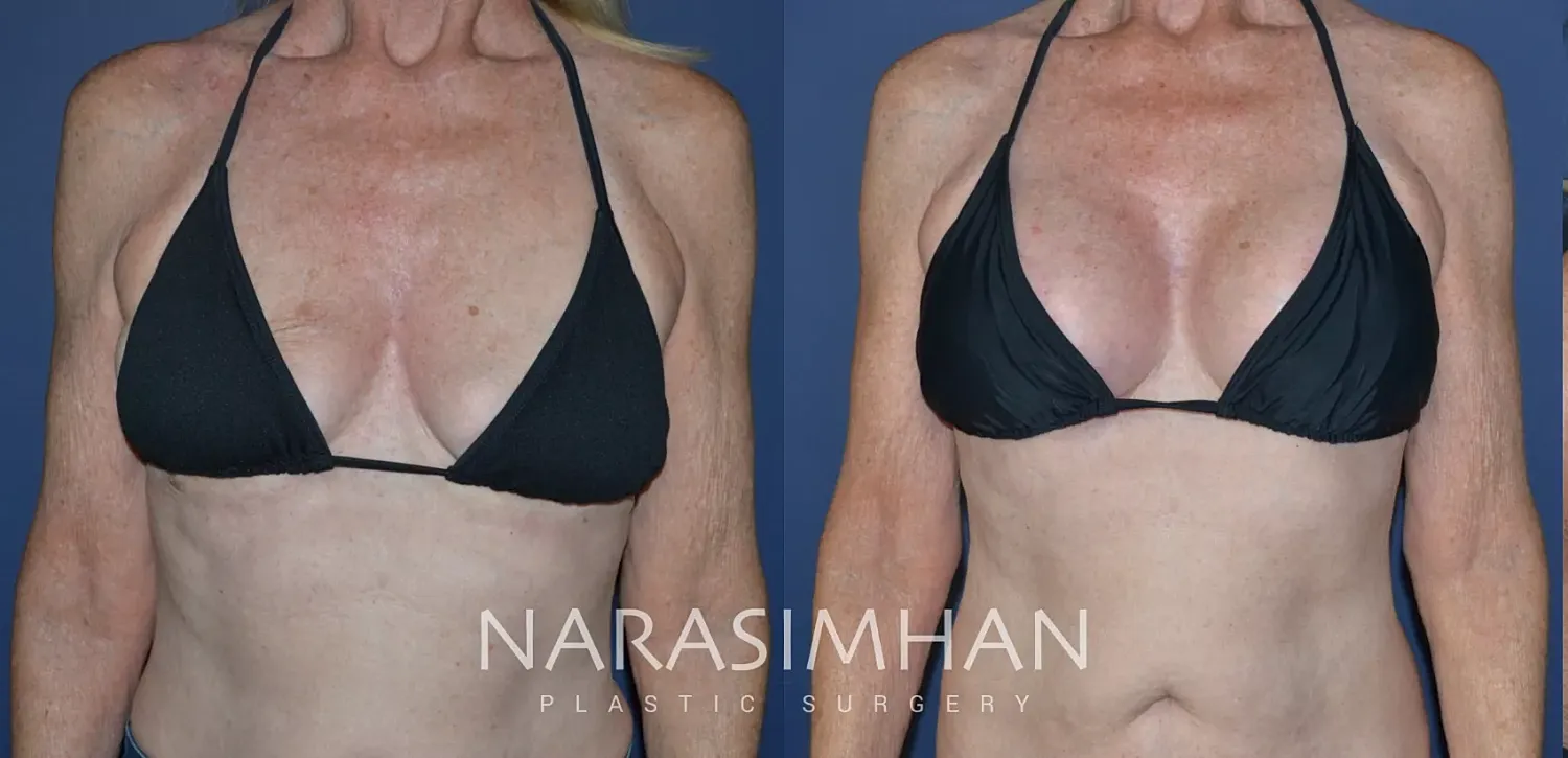 Breast Enhancement Before & After