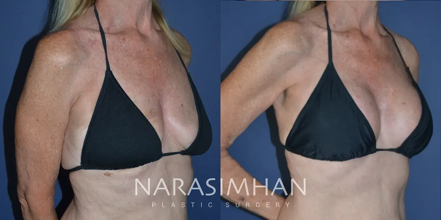 Breast Enhancement Before & After