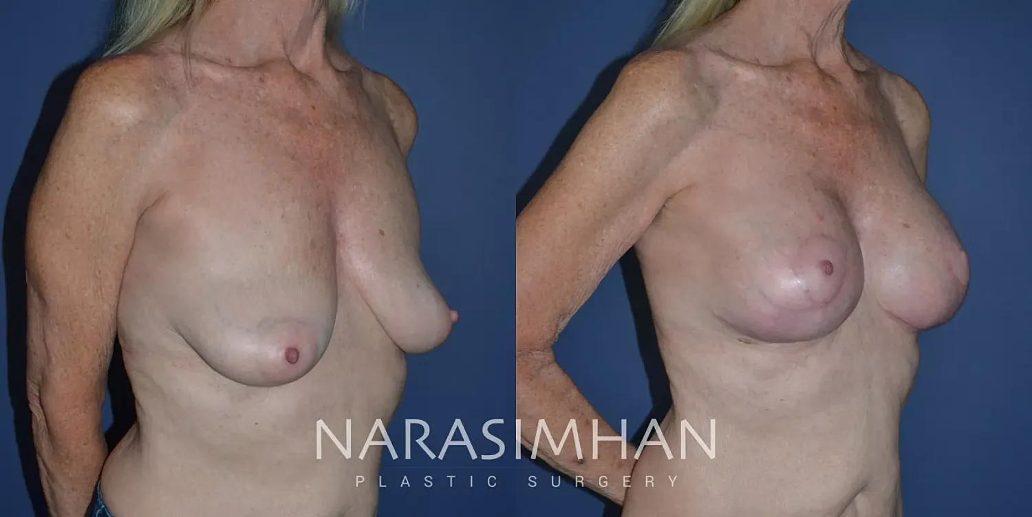 Breast Enhancement Before & After