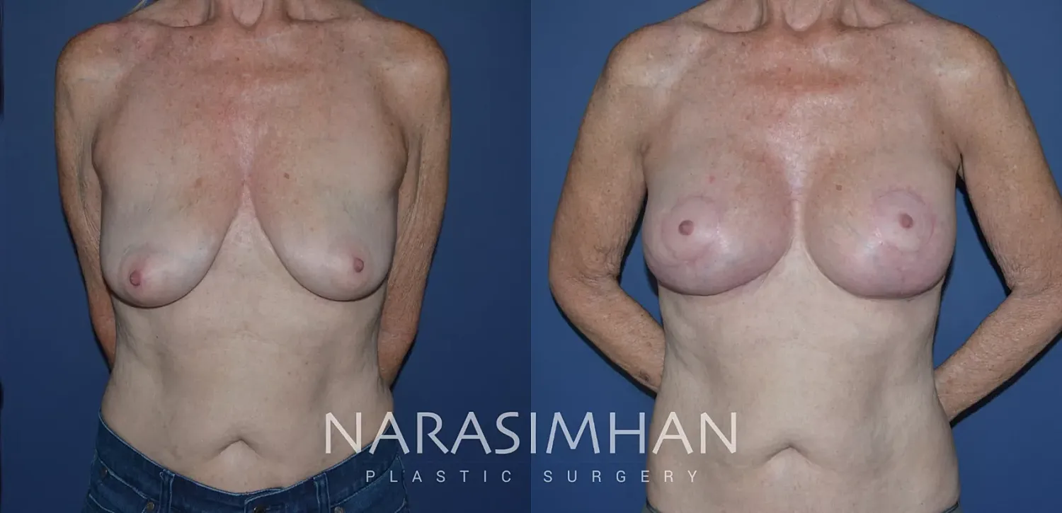 Breast Enhancement Before & After