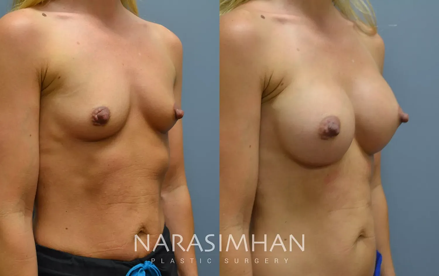 Breast Enhancement Before & After