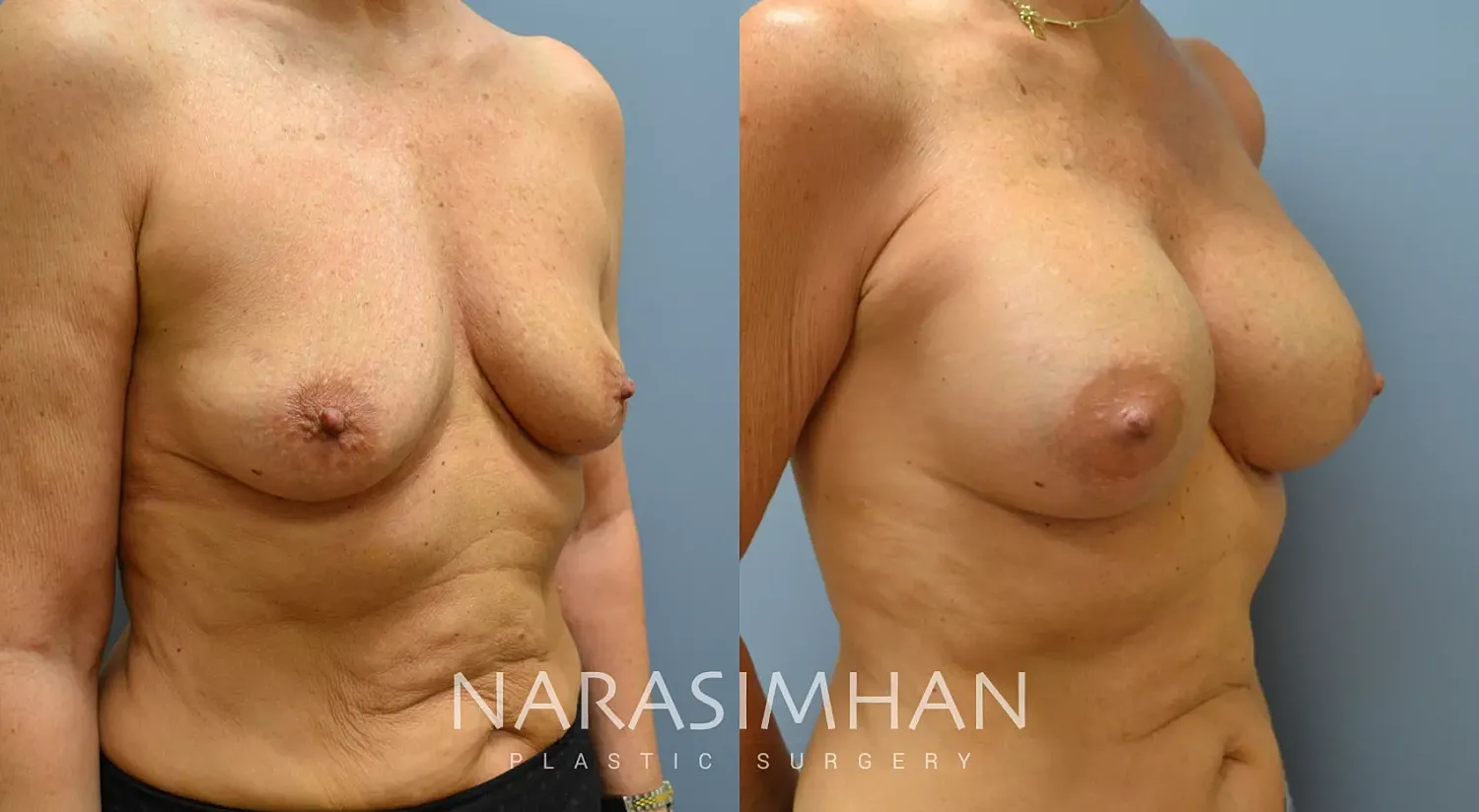 Breast Enhancement Before & After