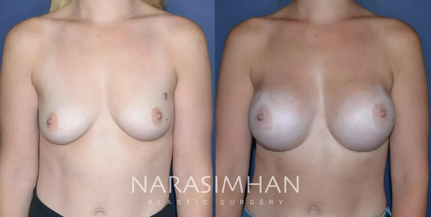 Breast Enhancement Before & After