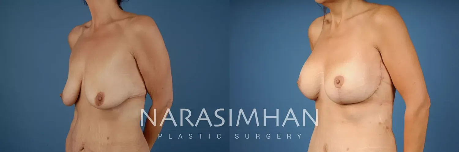 Breast Enhancement Before & After