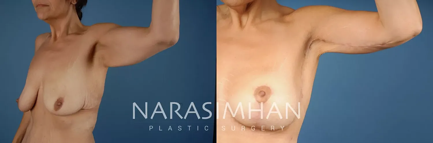 Breast Enhancement Before & After