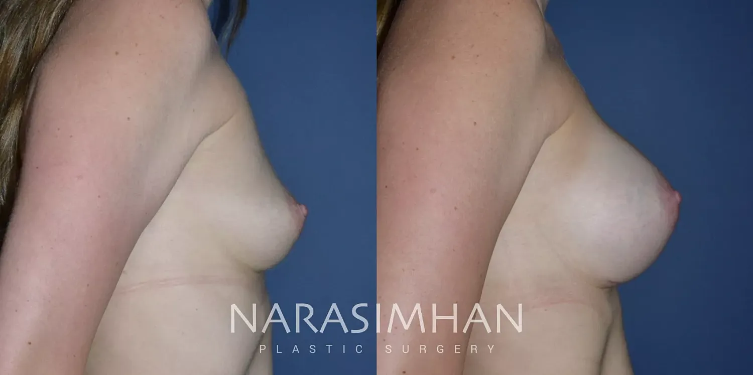 Breast Enhancement Before & After